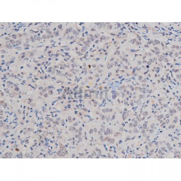 Phospho-Tau (Thr181)[Thr498] Antibody - AF3149 at 1/200 staining Human ganstric cancer tissue sections by IHC-P.